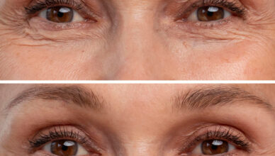 Blefaroplastia