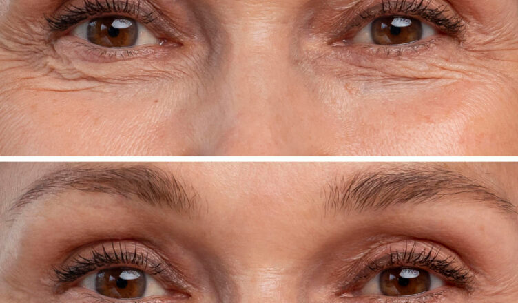 Blefaroplastia