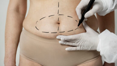 abdominoplastia