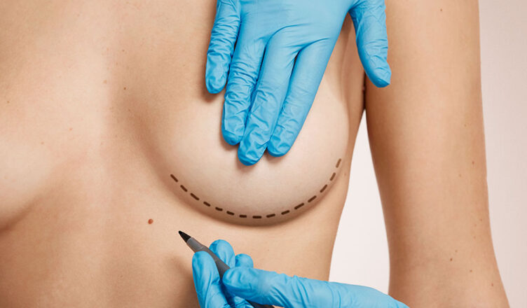 Procedimento estético Mamoplastia